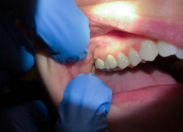 Best Knocked-Out Tooth Emergency  in Mount Vernon, IL
