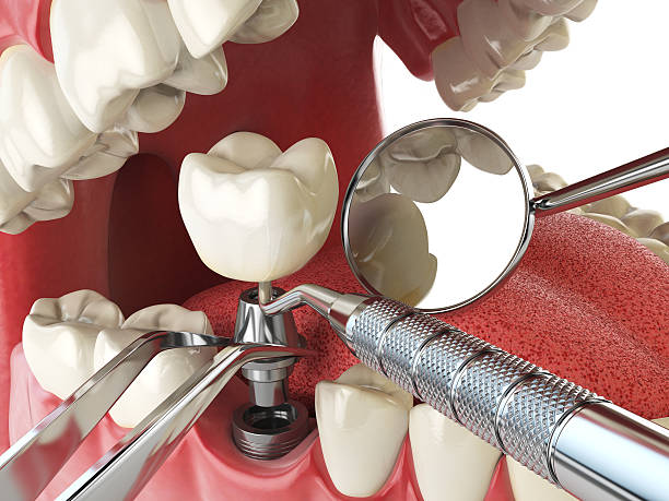 Best Emergency Tooth Extraction  in Mount Vernon, IL